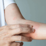 Psoriasis Treatment in Gurgaon: Complete Guide for Patients